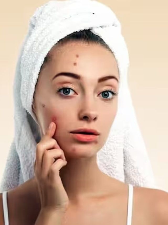 একদিনেই দূর হবে ব্রণ, মেনে চলুন এই ৬ টোটকা