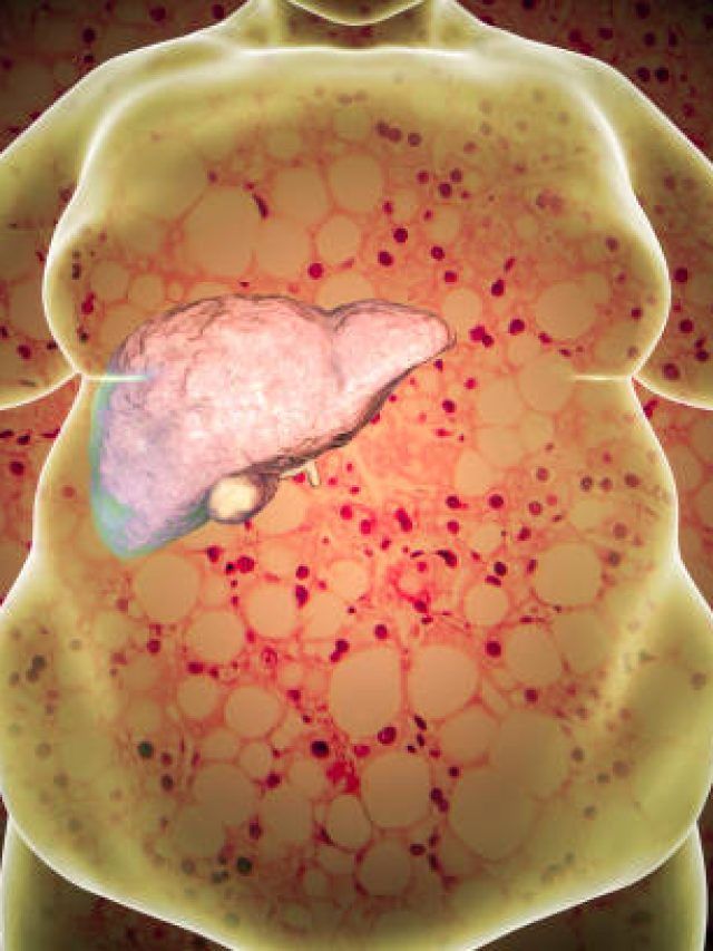 बिना मेहनत और एक्सरसाइज 30 दिन में कम होगा वजन, वेट लॉस के तरीके पर बोले डॉक्टर सरीन