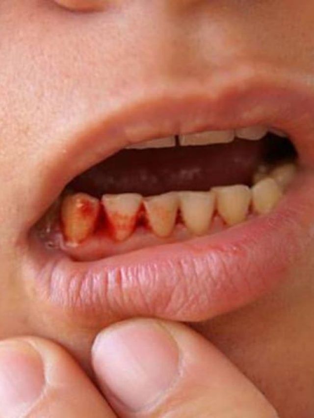 मुंह के छालों से परेशान हैं, तो रसोई की ये 4 चीजें लगाने से तुरंत मिलेगा आराम