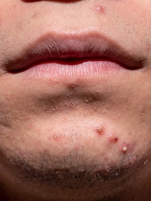 गर्मियों में पाना चाहते हैं ग्लोइंग स्किन? इन चीजों को खाना कर दें बंद