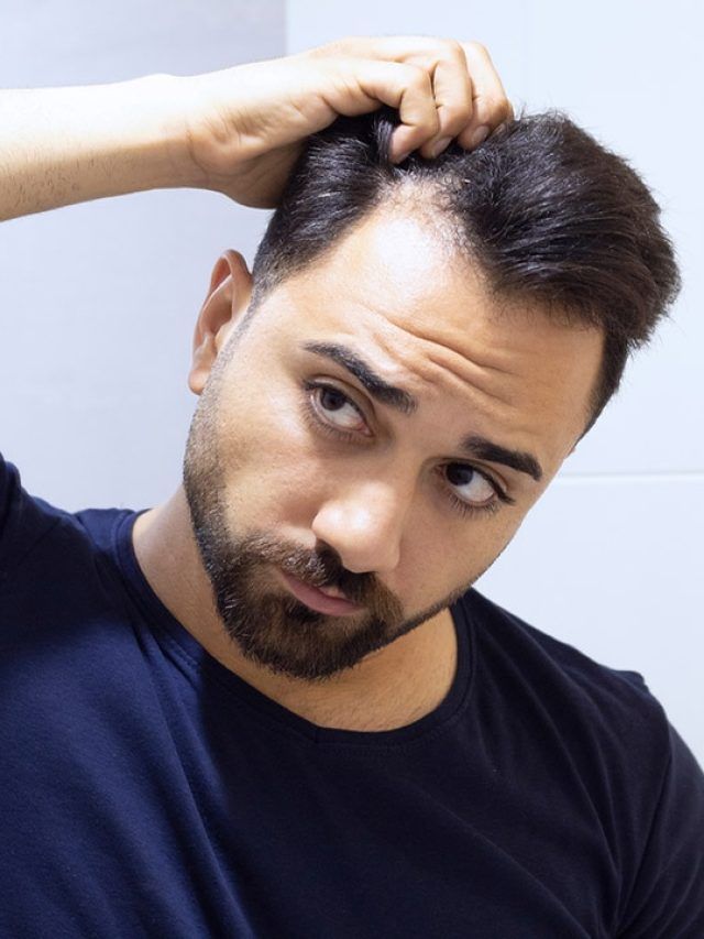 Bald before 25: The silent crisis Gen Z men don't talk about