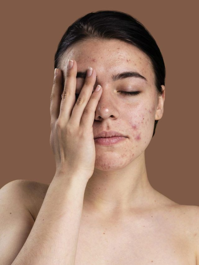 कील-मुंहासों ने बिगाड़ दिया है चेहरा का लुक, अपनाएं ये आसान तरीके