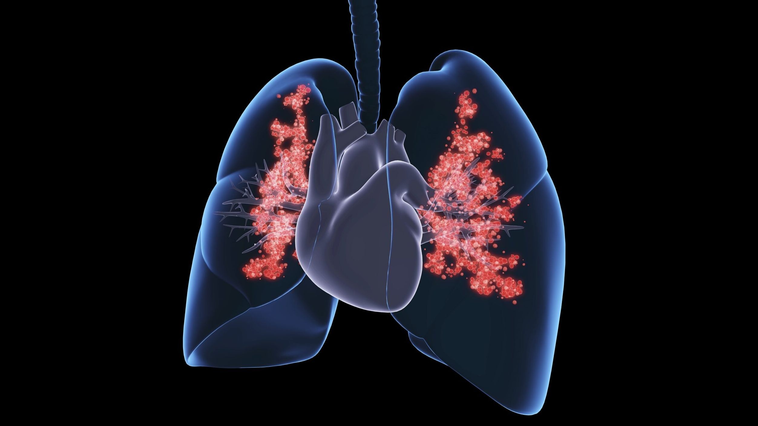 5 reasons why lung cancer is affecting non-smokers thumbnail