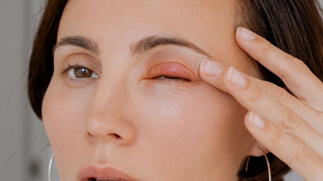 Red Eyes in Monsoon? Here's How to Treat Them