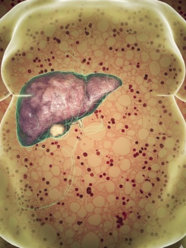 फैटी लिवर से छुटकारा दिला सकती हैं ये 3 चीजें, Liver का फैट और सूजन भी होगी दूर