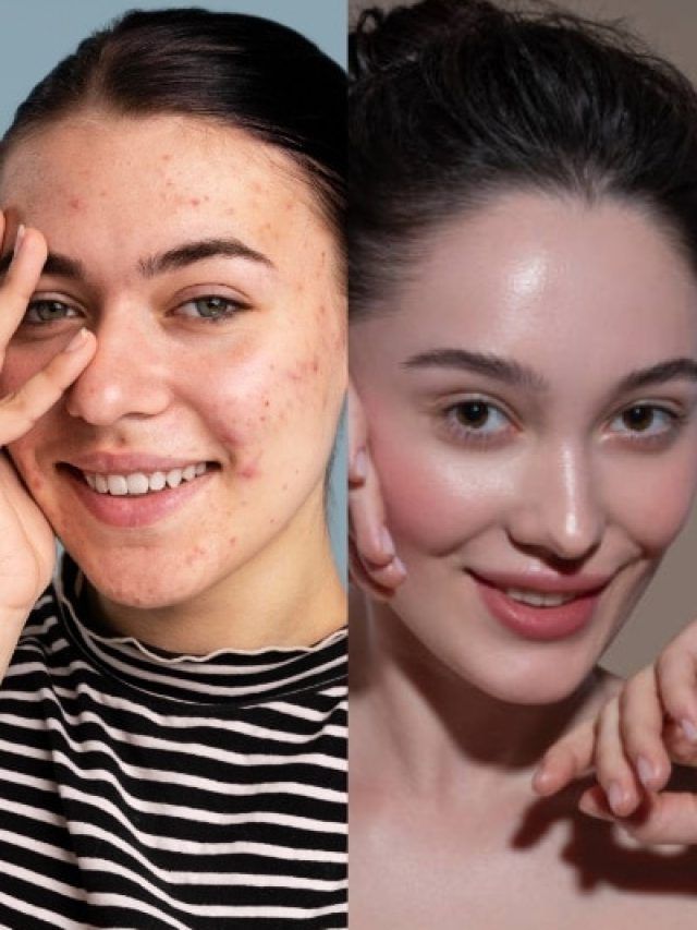 पिंपल्स को कहें बाय! चेहरे की सुंदरता बिगाड़ रहे मुंहासों से ऐसे पाएं छुटकारा