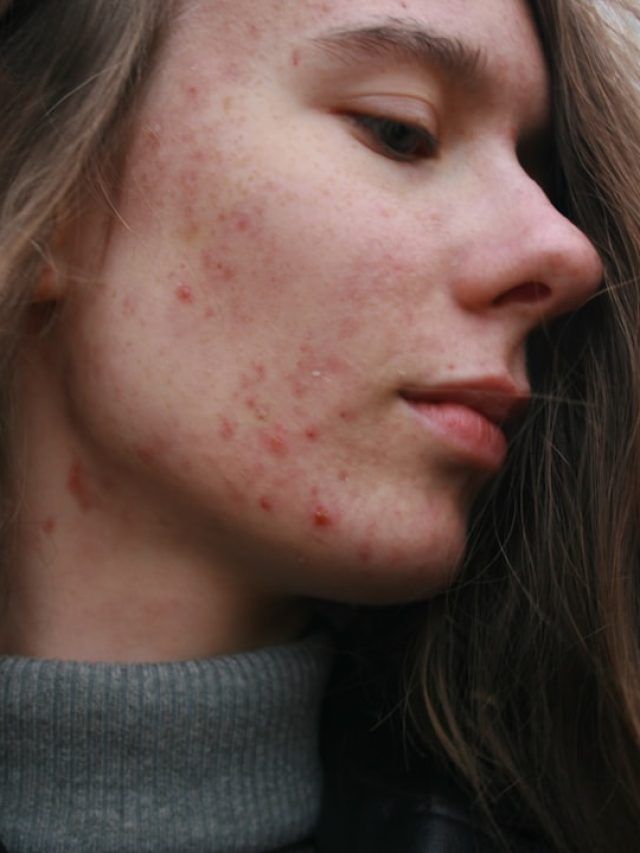 एक्ने से बचना चाहते हैं? इन सिंपल 5 हैक्स से मिलेगी मदद