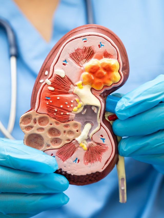 Kidney stone prevention made simple: the mineral your body actually needs