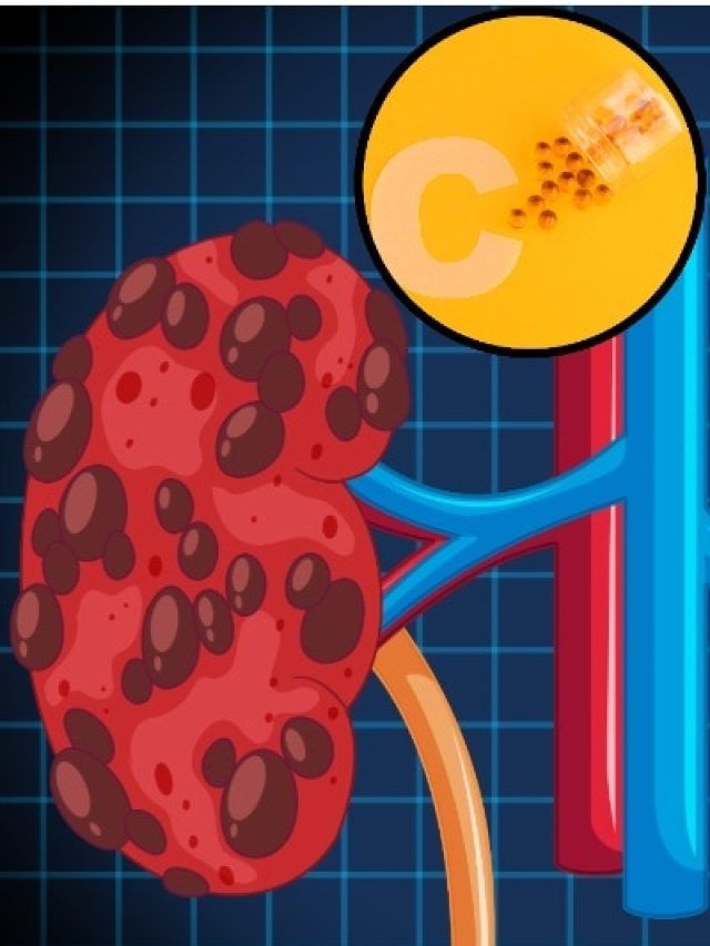 किडनी स्टोन का जोखिम बढ़ा सकती हैं विटामिन C की गोलियां, डॉक्टर ने दी चेतावनी