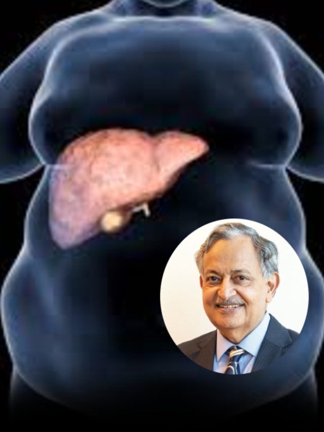 फैटी लिवर वालों को घी खाना चाहिए या नहीं? लिवर स्पेशलिस्ट डॉ. सरीन ने बताया