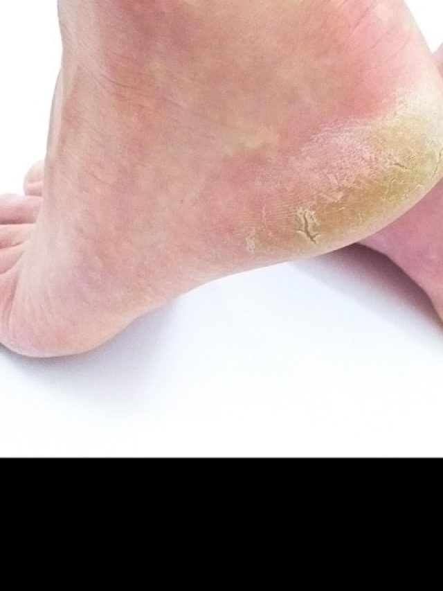 सिर्फ ठंड नहीं, इन विटामिन्स की कमी से भी फटती हैं एड़ियां! जानिए