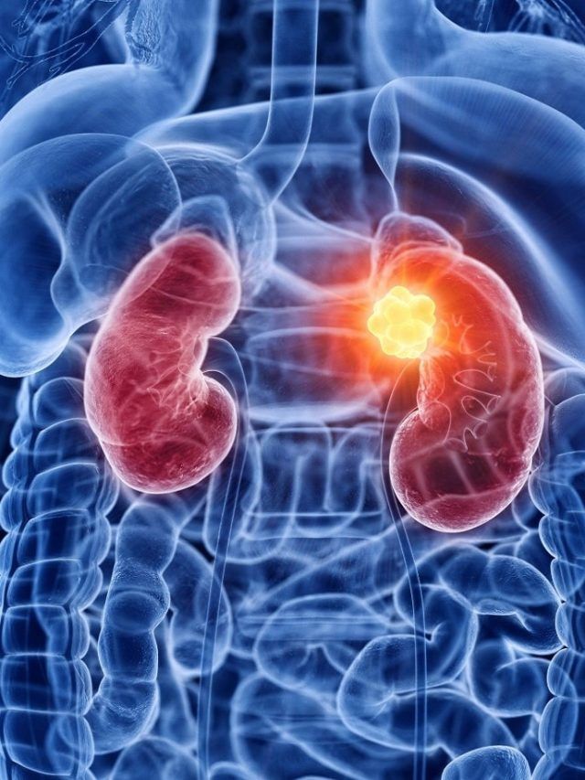 किडनी में जमी गंदगी साफ करेंगे ये 5 फूड्स, घटेगा Kidney Damage का खतरा