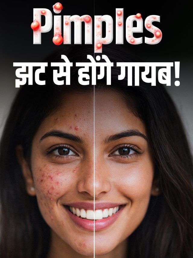 Pimples से पाना है छुटकारा? डॉक्टर ने बताएं देसी नुस्खे, तुरंत दिखने लगेगा असर!